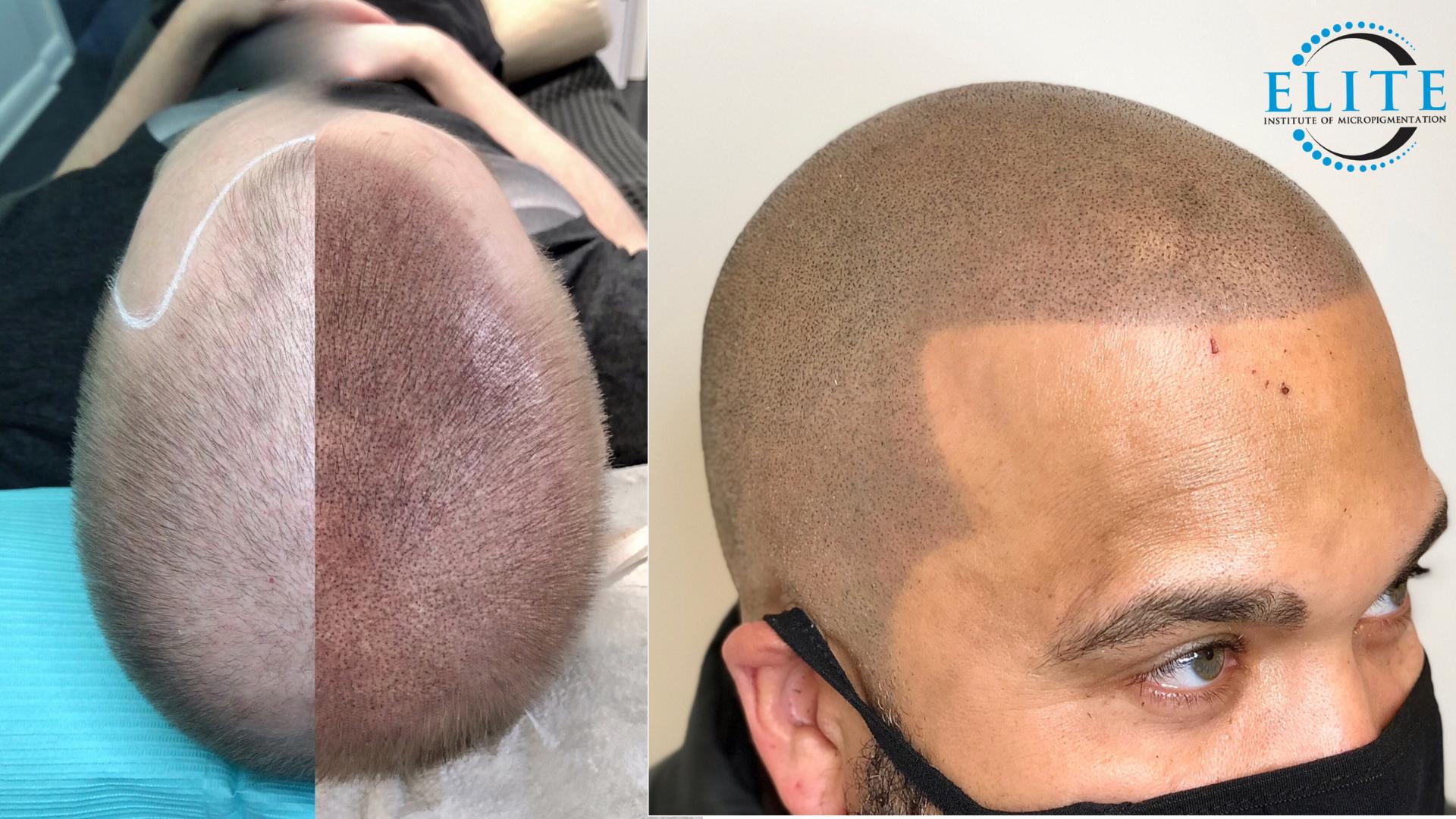 Scalp Micropigmentation  Before and After