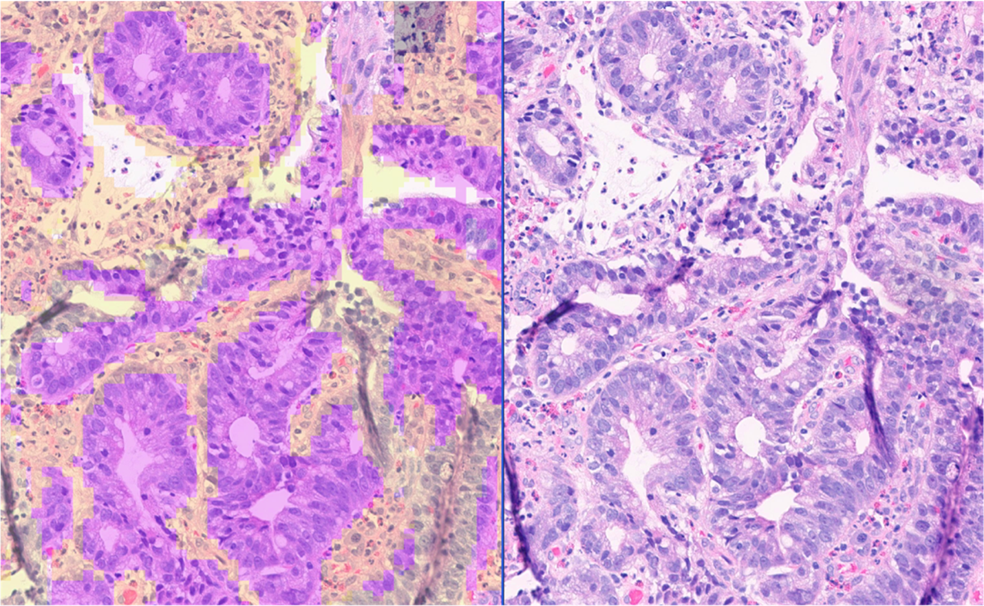 Caption: TumorDetect detects regions of artifact (yellow overlays) invasive gastric adenocarcinoma (purple overlays) as well as tumor-associated stroma (orange overlays).